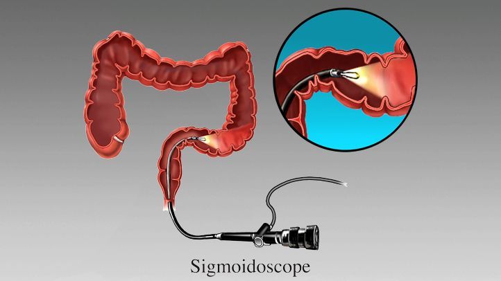 Sigmoidoscopy